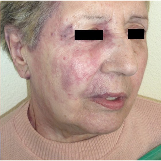 Cynergy treatment - before and after - image 003 - after