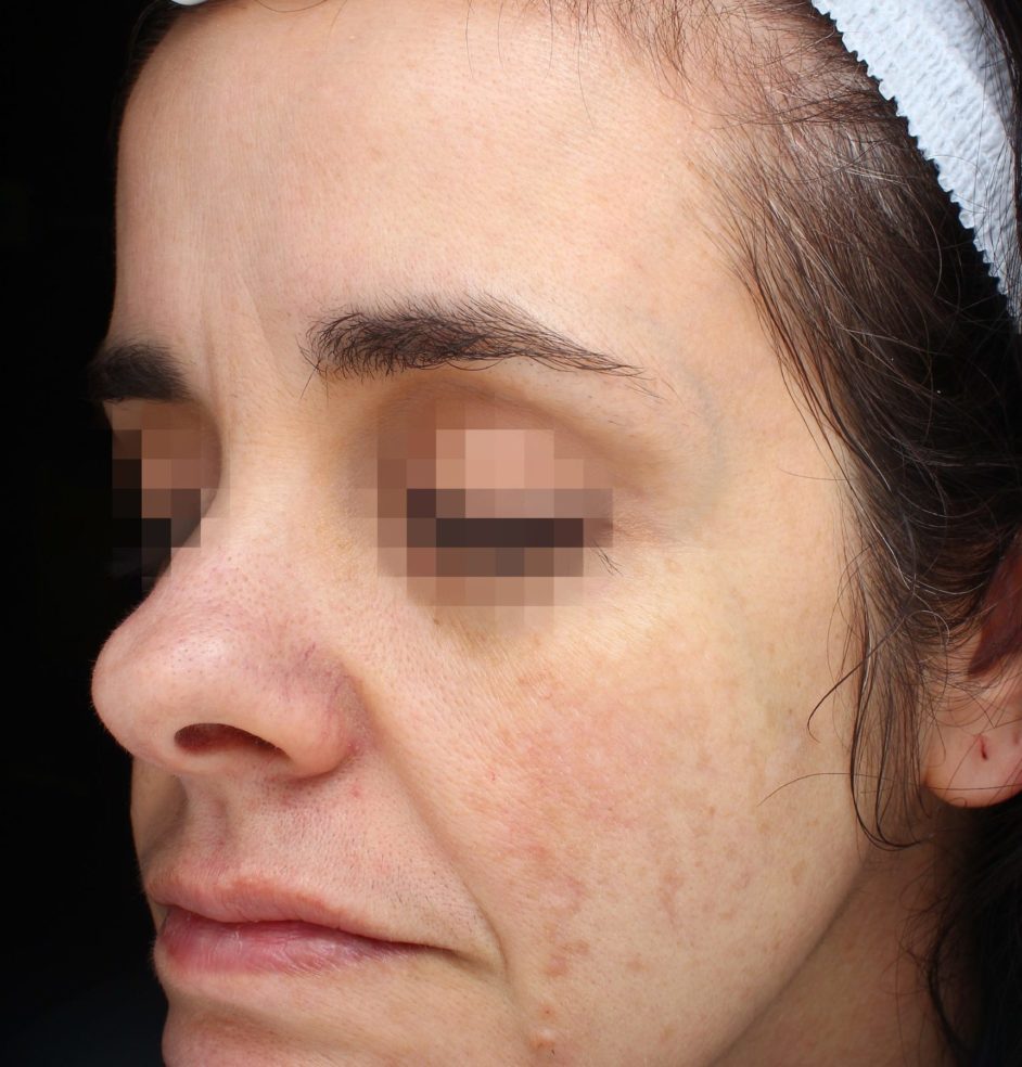 prd_4844_picosure-pro-before-after-photo-dr-weiss